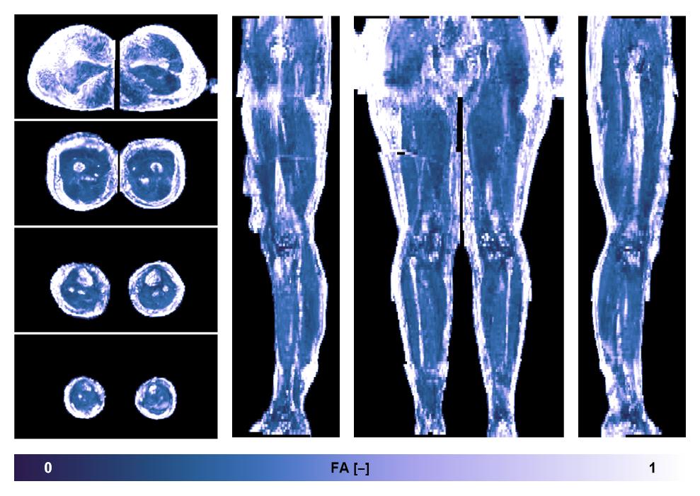 IVIM corrected whole leg muscle fractional anisotropy obtained from diffusion tensor imaging.